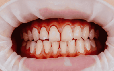Gencives qui saignent : causes, signaux d&rsquo;alerte et quand consulter un dentiste ?