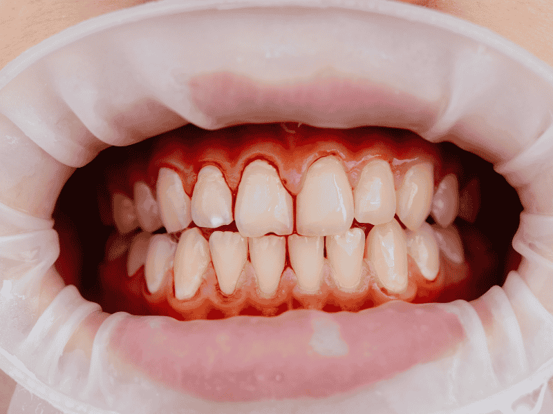 Gencives qui saignent : causes, signaux d&rsquo;alerte et quand consulter un dentiste ?